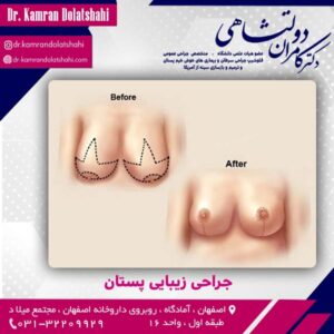 جراحی زیبایی پستان - دکتر دولتشاهی