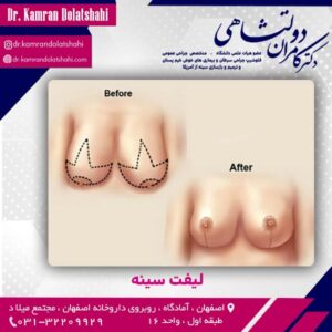 لیفت سینه - دکتر دولت شاهی