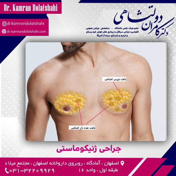 جراحی ژنیکوماستی