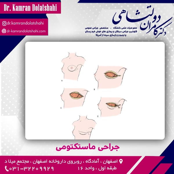 جراحی ماستکتومی - دکتر دولتشاهی