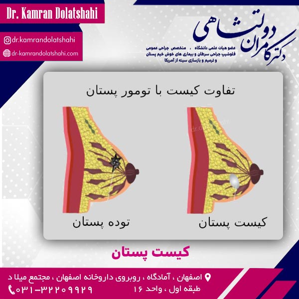 کیست پستان