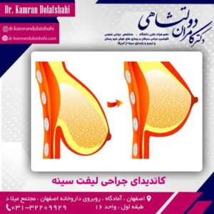 لیفت سینه
