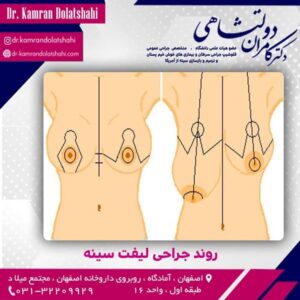 لیفت سینه - دکتر دولتشاهی
