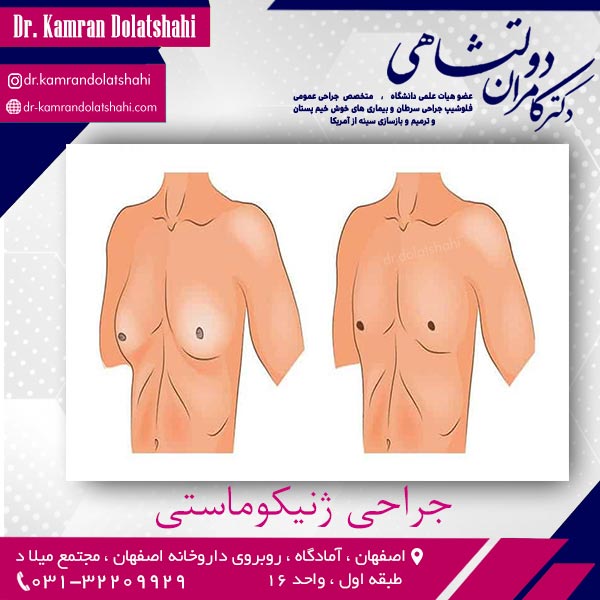 جراحی ژنیکوماستی