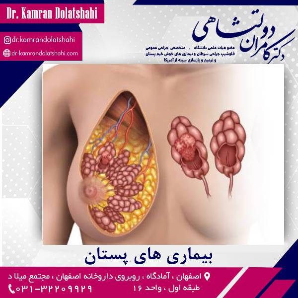 بیماری های پستان