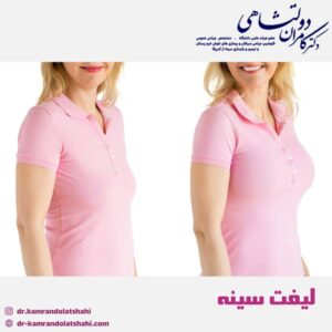 لیفت سینه - دکتر دولتشاهی