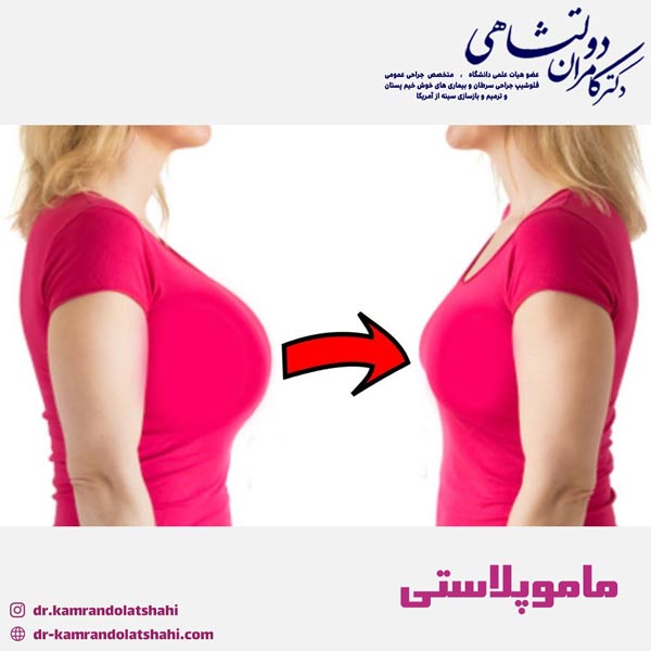 ماموپلاستی - دکتر دولتشاهی