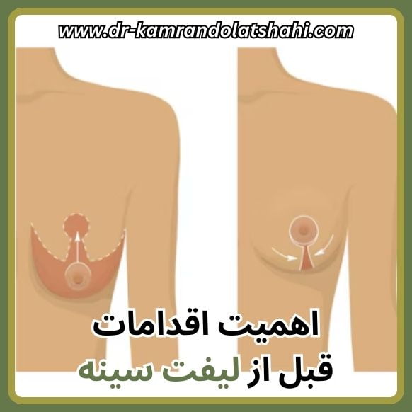 اقدامات مهم قبل از عمل لیفت سینه