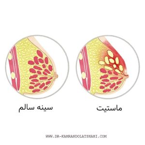 درمان ماستیت پستان در اصفهان _ دکتر کامران دولتشاهی