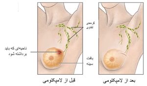 جراحی لامپکتومی در اصفهان _ دکتر کامران دولتشاهی 