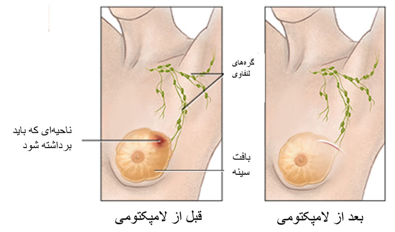 جراحی لامپکتومی در اصفهان _ دکتر کامران دولتشاهی 