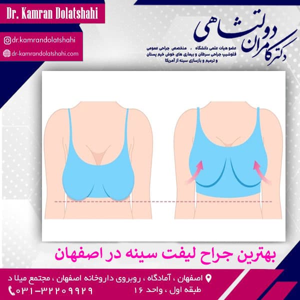 بهترین جراح لیفت سینه در اصفهان - دکتر کامران دولتشاهی