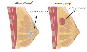 تفاوت کیست سینه و تومور سینه _ دکتر کامران دولتشاهی