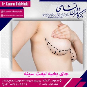 جای بخیه لیفت سینه - دکتر دولتشاهی