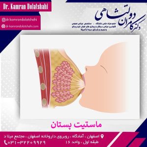 ماستیت (التهاب ) پستان - دکتر دولتشاهی