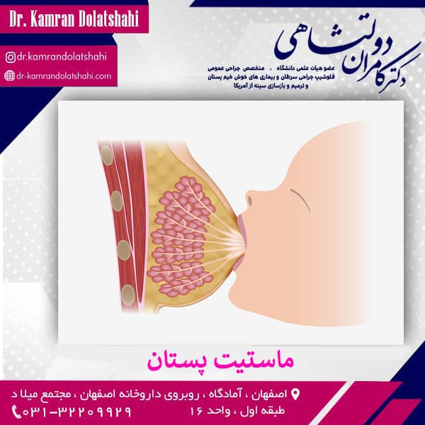 ماستیت (التهاب ) پستان - دکتر دولتشاهی