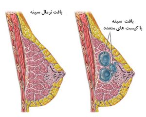 کیست سینه _ دکتر کامران دولتشاهی