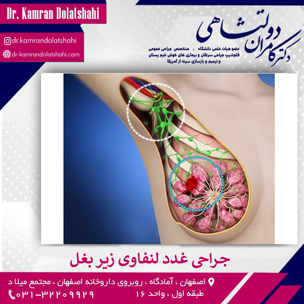 جراحی غدد لنفاوی زیر بغل