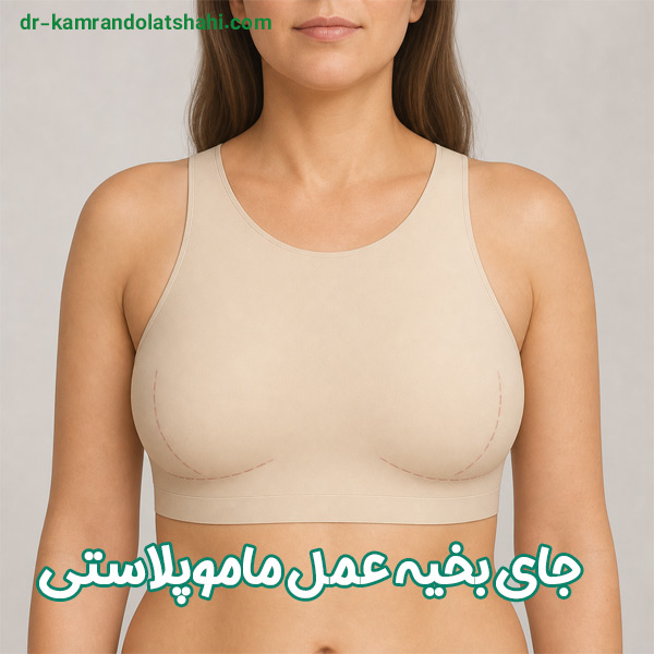 جای بخیه عمل ماموپلاستی - دکتر دولتشاهی