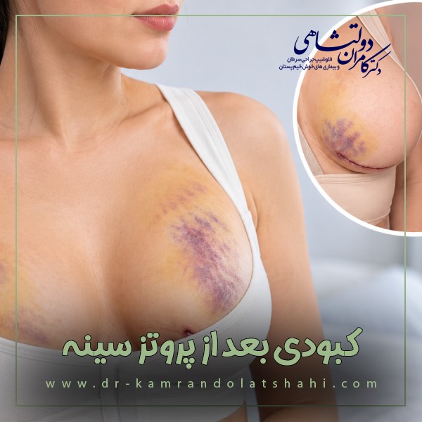 کبودی بعد از پروتز سینه